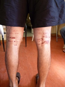 injuries from the clothes after 9 hours in the sea on Wahids body